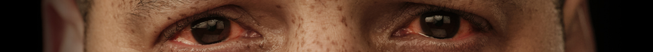 Thyroid Eye Disease Triggers and Flares