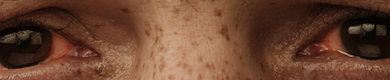 Thyroid Eye Disease Triggers and Flares