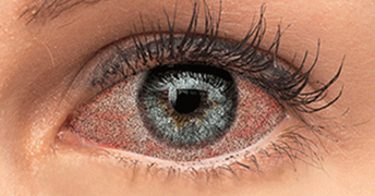 Dry, gritty eyes