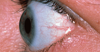 Bulging eyes