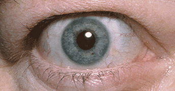 Eyelid retraction