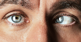 Misaligned eyes
