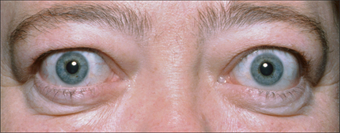 A patient with Thyroid Eye Disease demonstrates eyelid retraction and proptosis.