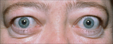 A patient with Thyroid Eye Disease demonstrates eyelid retraction and proptosis.