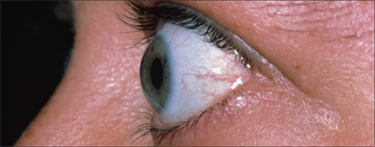 A patient with Thyroid Eye Disease demonstrates eyelid retraction and proptosis.