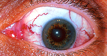 Red eyes