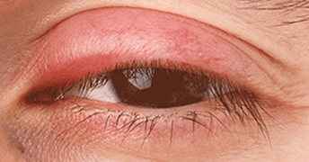 Swollen, puffy eyelids