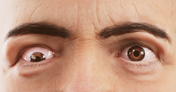misaligned-eyes